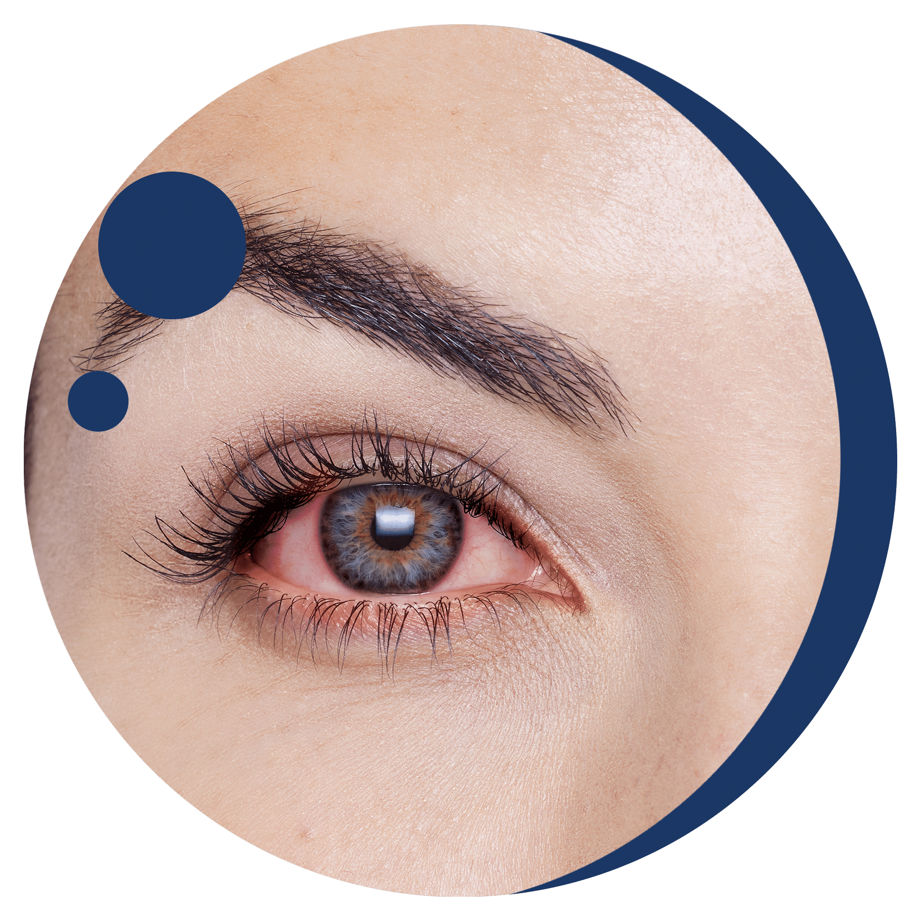 allergie oculari
